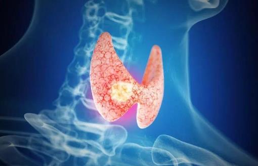 哪些人易患结节性甲状腺肿？结节性甲状腺肿怎么治疗？