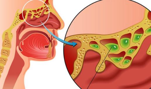 什么是副鼻窦炎？副鼻窦炎有哪些症状？