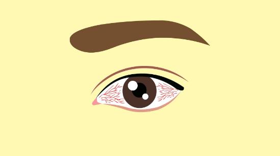 眼睛充血注意什么？眼睛充血的原因有哪些？