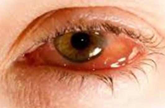 眼睛眼屎多正正常吗？眼睛眼屎多的原因有哪些？