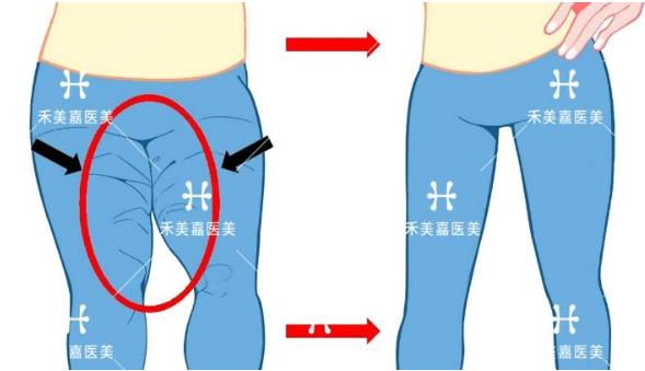 大腿吸脂术后会留疤吗，听听北京禾美嘉整形医院任学会的回答