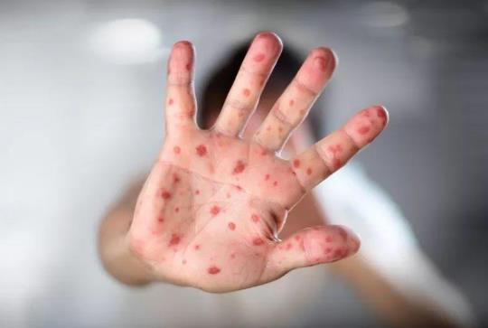 手足口病怕高温吗？手足口病不吃药能治愈吗