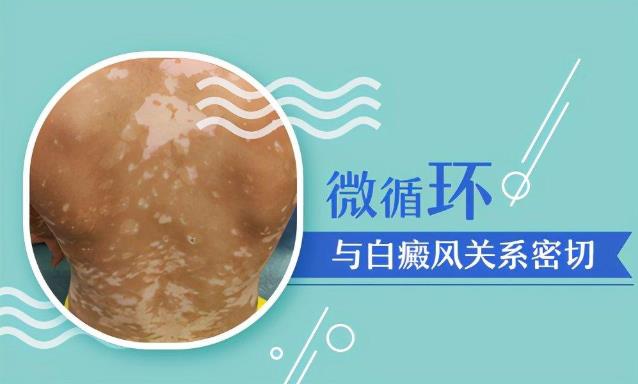 杭州华研白癜风医院：白癜风罪魁祸首早发现早改善，祛白更快！