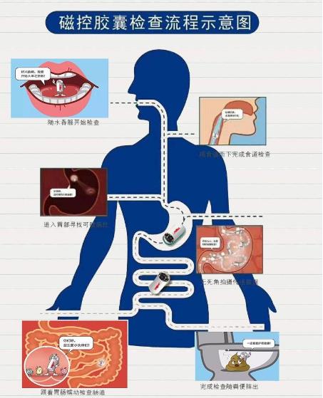 南宁东大医院这颗电子胶囊胃镜作用太奇妙，再也不用怕胃镜检查～