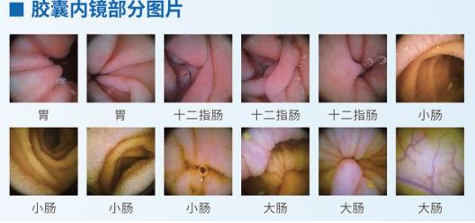 什么？做胃镜检查竟不用插管？揭秘南宁东大智能磁控胶囊胃镜系统