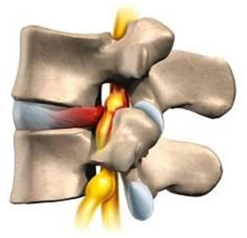 腰椎间盘突出到底是怎么回事，憬康职业教育给您解答