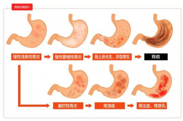 无症状被查出了胃癌……很多悲剧几乎每天在消化内镜中心上演！