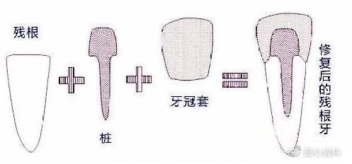 武汉仁爱口腔医师告诉你牙齿不做管“冠”，早晚是后患需慎重！