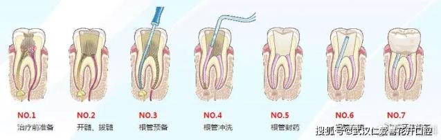 武汉仁爱口腔医师告诉你牙齿不做管“冠”，早晚是后患需慎重！