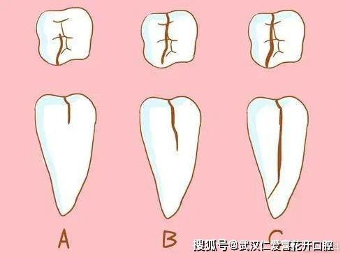 武汉仁爱口腔医师告诉你牙齿不做管“冠”，早晚是后患需慎重！