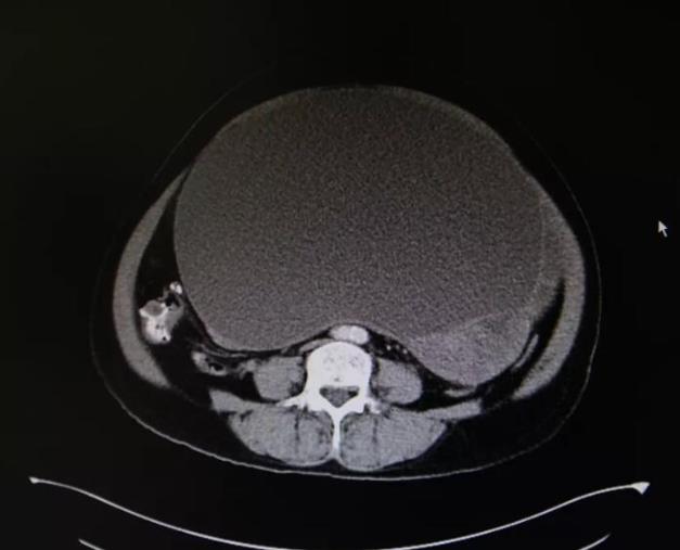 佛山肿瘤医院推荐广州复大肿瘤医院：成功摘除盆腹腔巨瘤