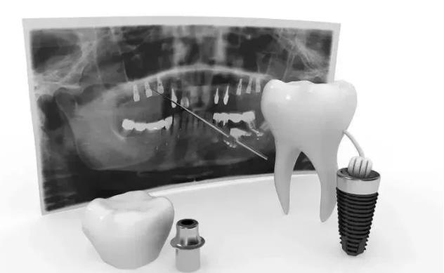 武汉种植牙价格因素大揭秘——种植牙值多少钱？