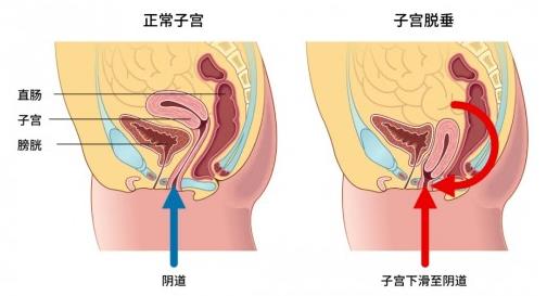 大连美琳达妇科医院：关于漏尿，众多女性的难言之隐怎么改