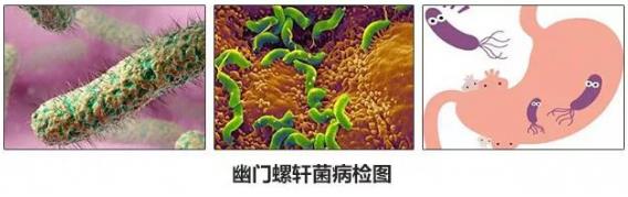 呼市东大肛肠医院 只要做到一件事，胃癌将是少见癌症