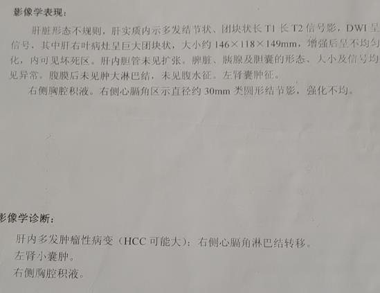 在线等-印度瑞戈非尼效果到底怎么样啊？买一盒瑞戈非尼价格中国和印度为何不一样？