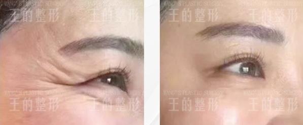 赶走皱纹，王海木院长说这些方法足够了