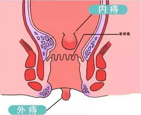 西安东大肛肠医院：痔疮还分软硬，硬的和软的有啥区别？