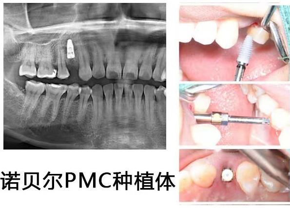 武汉种植牙医院排名#武汉仁爱口腔#带您直击种植手术现场，见证缺牙重生秘密！