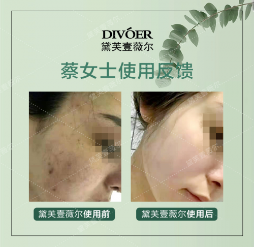 黛芙壹薇尔用多久见效果 揭秘黛芙壹薇尔真实祛斑效果