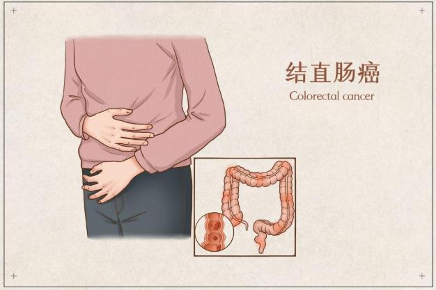 泰莱生物助力结直肠癌筛查诊断提高准确性