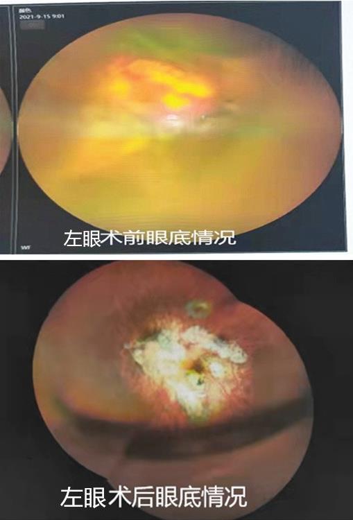 2500度超高度近视又白内障又眼底问题 上海眼科医生“一提一保”治疗方案挽救她的