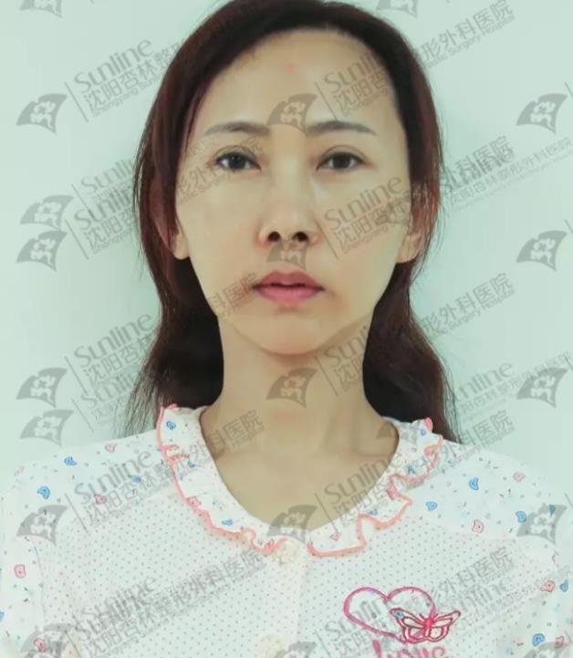 沈阳杏林整形外科医院自体脂肪面部填充费用