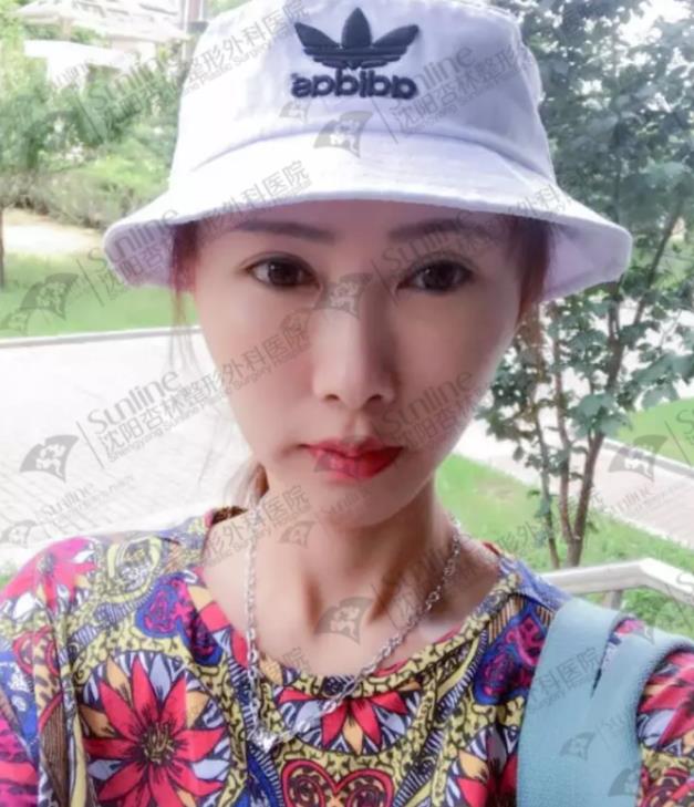 沈阳杏林整形外科医院自体脂肪面部填充费用