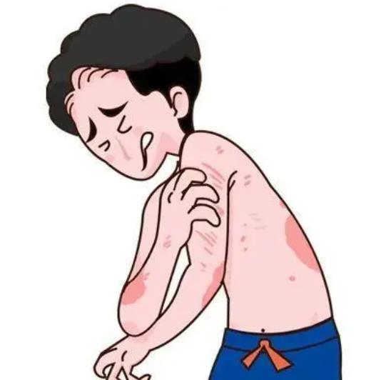 癣是怎么引起的？银屑病人怎么看待它？