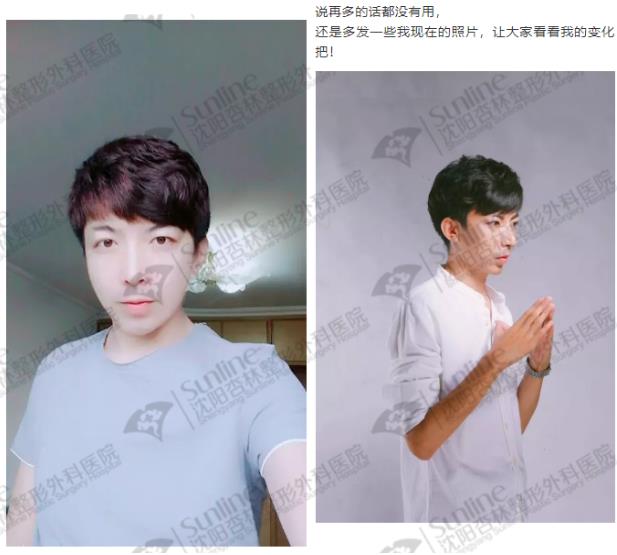 沈阳杏林整形外科医院：下颌后缩怎么办