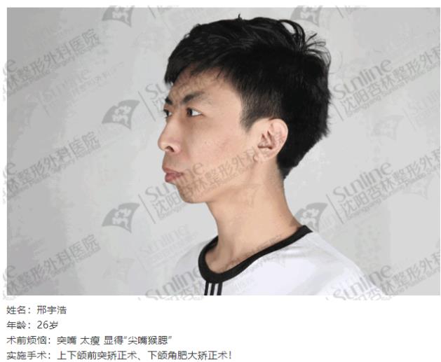 沈阳杏林整形外科医院：下颌后缩怎么办