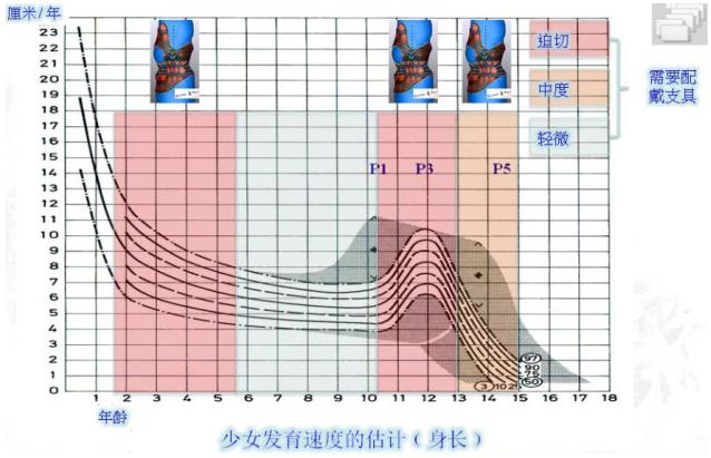 深圳龙脊康黄耿沛主任：脊柱侧弯如何科学预防