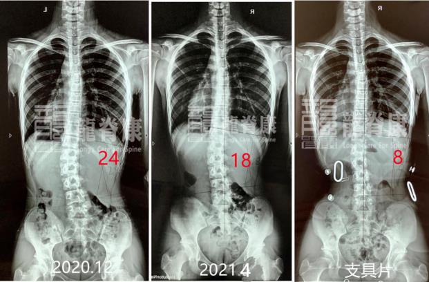 深圳龙脊康黄耿沛主任：脊柱侧弯如何科学预防