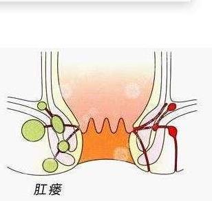 武汉江汉博仕医院：肛周脓肿怎么治疗？