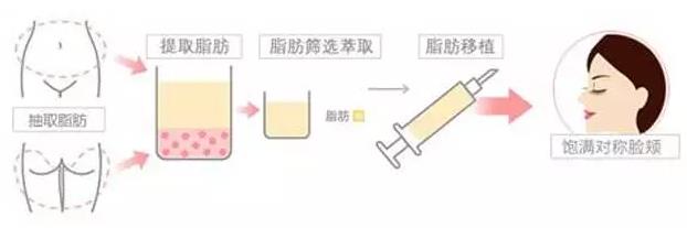 针对自体脂肪填充不了解这些最好别去做！【刘靖涛医生自体脂肪填充】