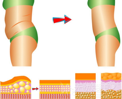 刘靖涛医生划重点：为什么有人做完腰腹吸脂效果好，有人做完变化不大?
