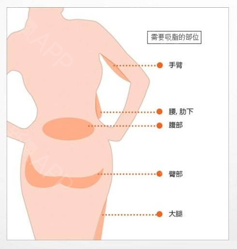 刘靖涛医生划重点：为什么有人做完腰腹吸脂效果好，有人做完变化不大?