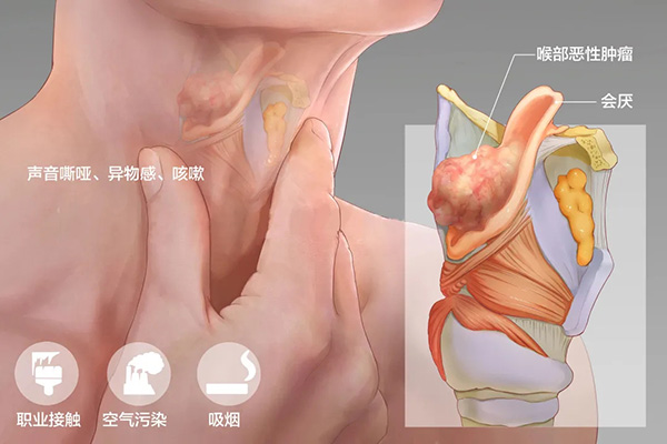 成都民生耳鼻喉医院科普 声音嘶哑是什么病