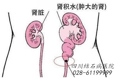 四川结石病医院辟谣：肾结石的江湖谣言，你信了几个？