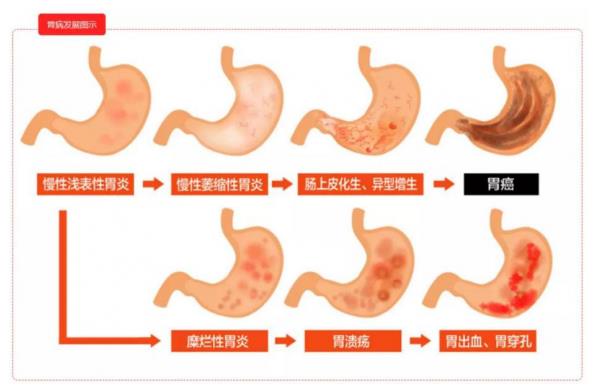 呼市东大肛肠医院 出现这7个征兆，要警惕胃癌！