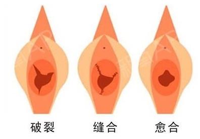 做处女膜修复的费用