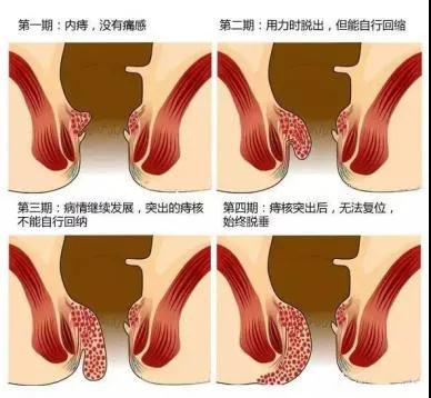 呼和浩特市东大肛肠医院如何避免痔疮术后后遗症，就医选择正规肛肠医院