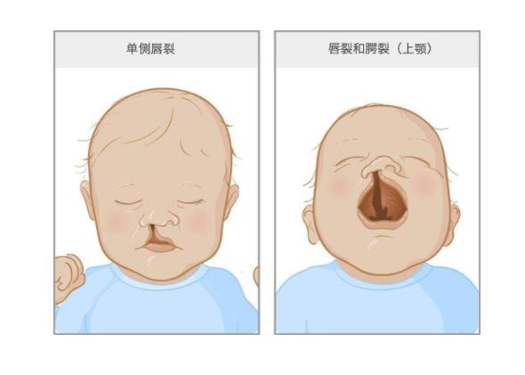 唇腭裂的图片，导致唇腭裂的相关因素有哪些？