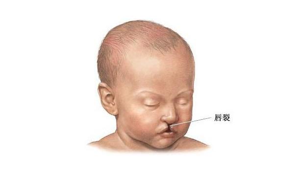 唇腭裂的图片，导致唇腭裂的相关因素有哪些？