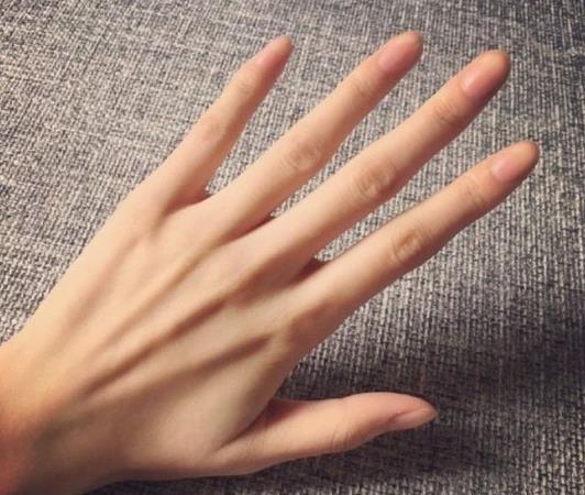手冻僵了怎么快速恢复？冻僵的手为什么不能拿热水泡