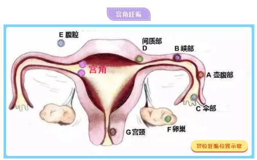 孕囊偏宫角≠宫角妊娠 郑州美中商都妇产医院成功助孕！！