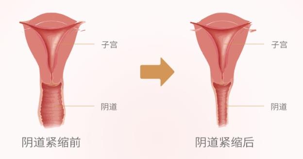 在贵阳丽都私密整形做紧缩手术有用吗