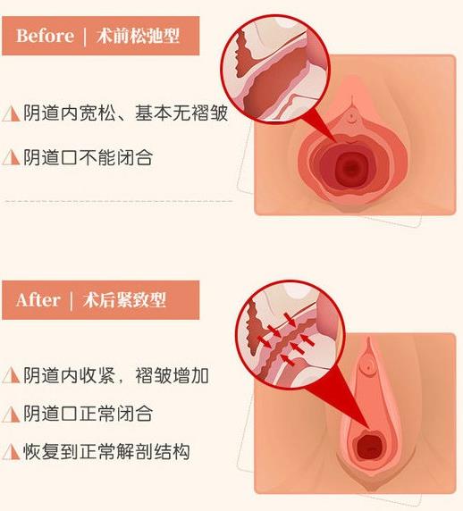 重庆哪家医院做缩阴手术做得好？