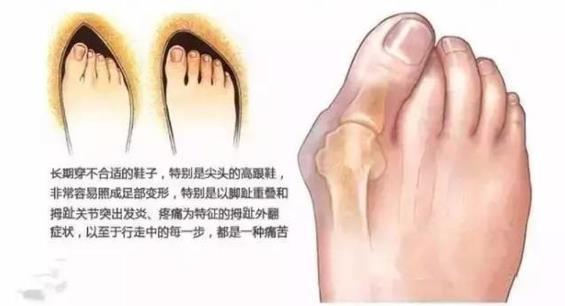 上海健桥医院侯明主任：大脚骨疼痛是痛风吗