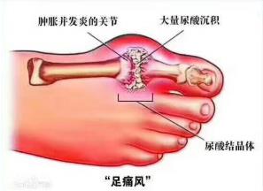 上海健桥医院侯明主任：大脚骨疼痛是痛风吗