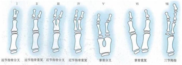 顺德和平医院手指再造还原 六指多指孩子手足畸形，过早手术有哪些好处？